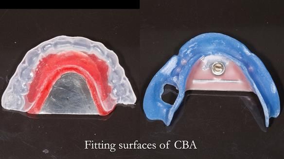 Newsletter 82 Mary - A complete upper and a one-tooth gasket denture