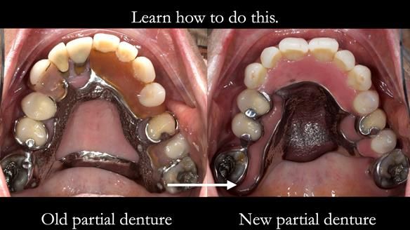 Finlay's Newsletter 59 Ultra hard partial dentures made for Gill
