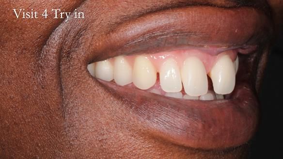 Newsletter 53 showing the making and fitting of ultra life-like dentures for Valena