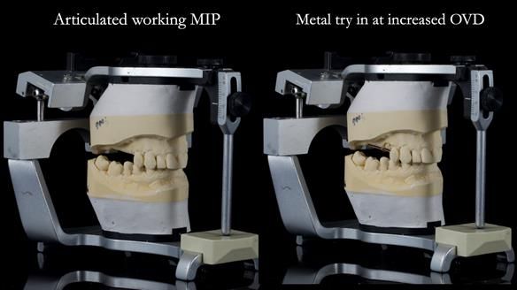 Finlay's Newsletter 64 case study - provision of a Kennedy class 2 metal based Scandinavian RPD for Ian