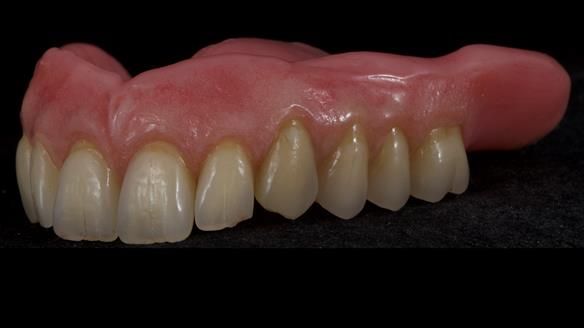 Newsletter 80 - Gordon’s dentures: the one case in 1,000 where my technique failed