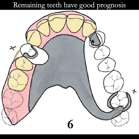 Universal Scandinavian partial denture designs