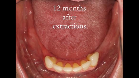 Newsletter 52 Managing Jo’s failing dentition with extractions and Mk 1/Mk 2 complete upper dentures and lower partial dentures FULL PROTOCOL
