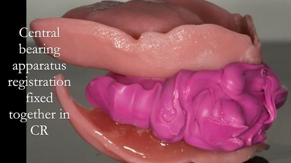 Newsletter 75: Marion’s case - Step-by-step complete denture workflow