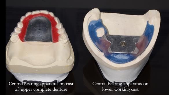 Newsletter 82 Mary - A complete upper and a one-tooth gasket denture