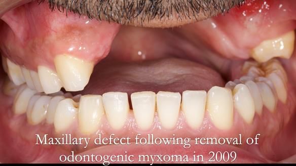 Upper metal base partial denture/occlusal stabilisation splint/obturator - full protocol