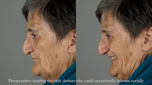 Newsletter 83: Sheila’s Complete Denture Success