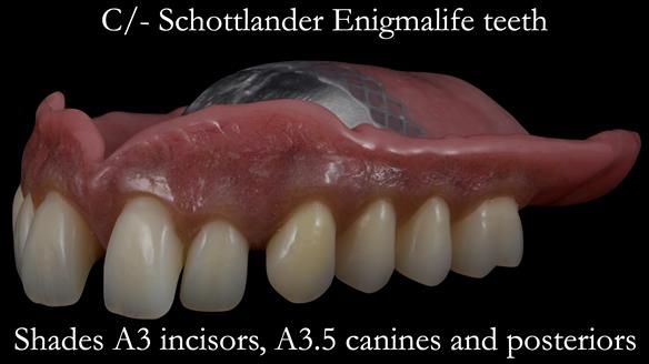 Newsletter 53 showing the making and fitting of ultra life-like dentures for Valena