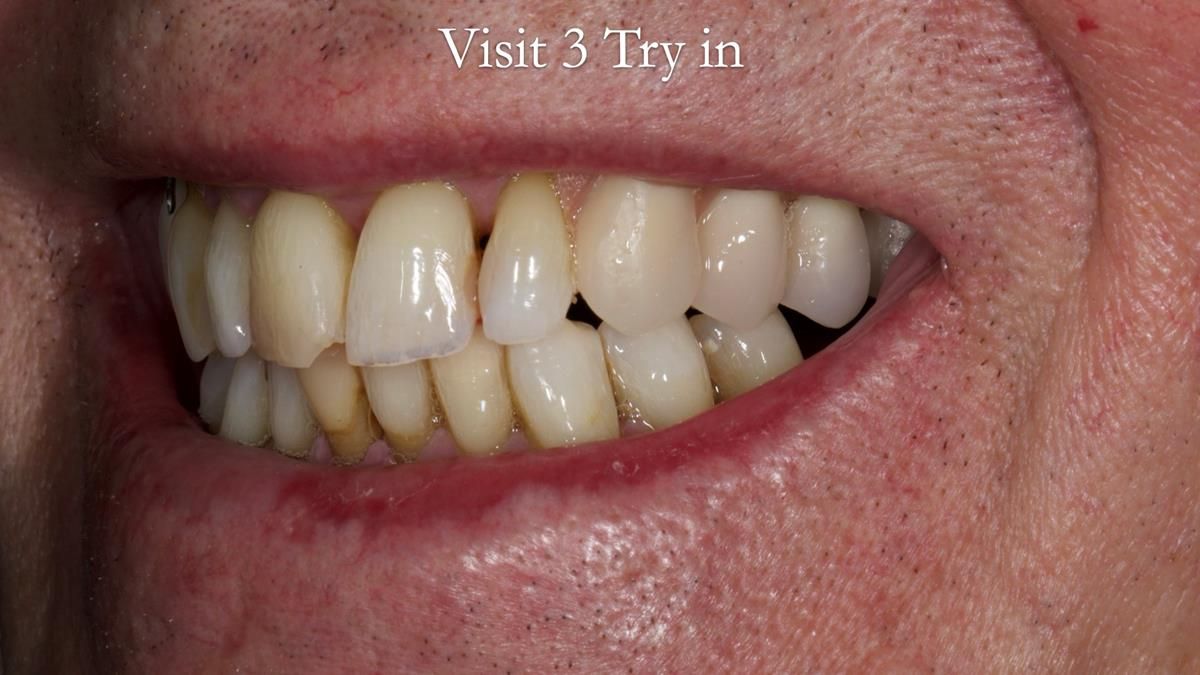 Newsletter 89 – Simon: A Challenging Kennedy Class II Division 1 Upper CoCr Partial Denture with a High Smile Line