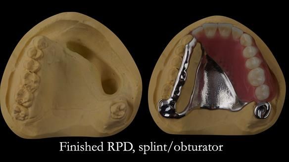 Upper metal base partial denture/occlusal stabilisation splint/obturator - full protocol