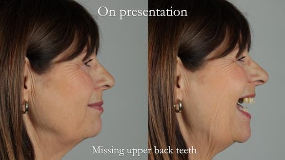 Newsletter 56 showing the making and fitting of a bilateral free end saddle upper removable partial denture (RPD) for patient with pemphigus