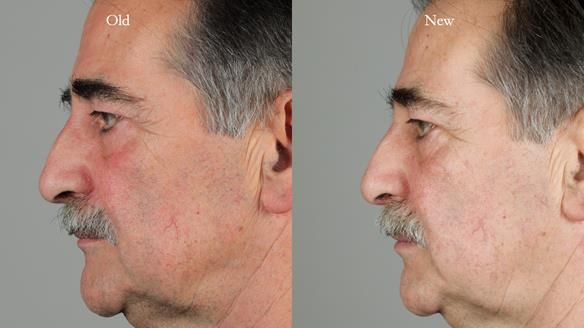 Newsletter 78: What do Clark Gable and a Locator® overdenture have in common?