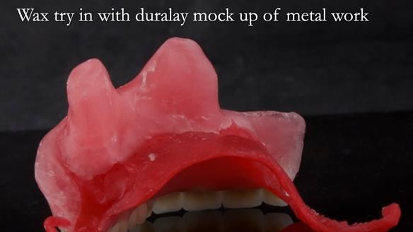 Upper metal base partial denture/occlusal stabilisation splint/obturator - full protocol