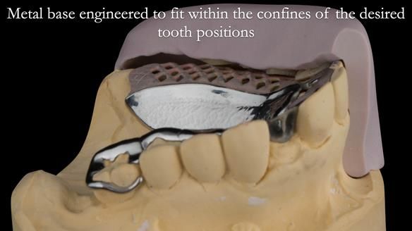 Newsletter 51 Managing Anne’s failing dentition with distal extension base RPD/Splint FULL PROTOCOL