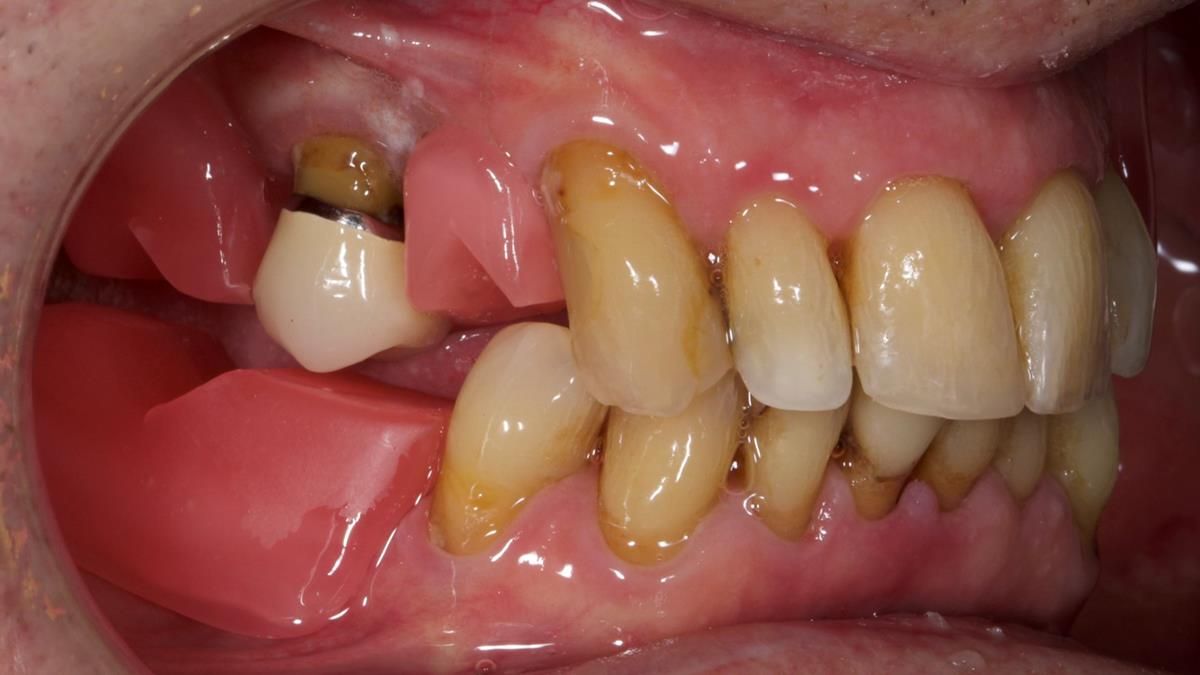 Newsletter 89 – Simon: A Challenging Kennedy Class II Division 1 Upper CoCr Partial Denture with a High Smile Line