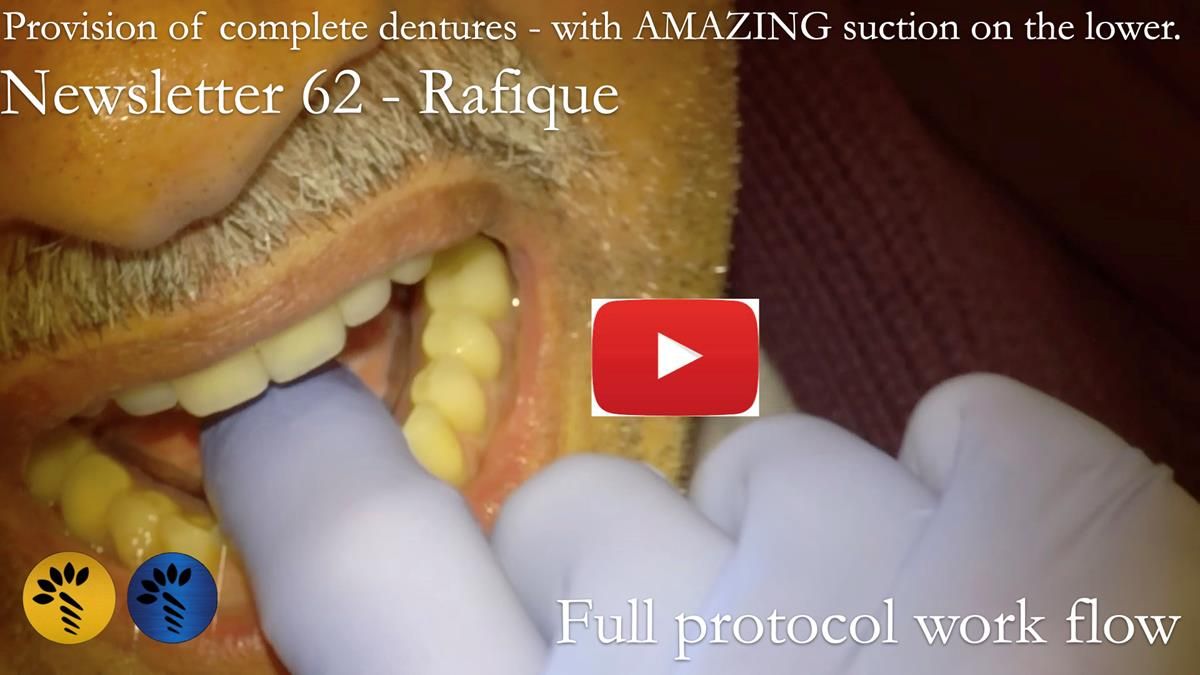 Finlay's Newsletter 62 provision of extractions and metal based complete dentures for Rafique