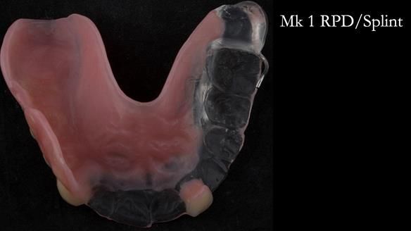 Newsletter 51 Managing Anne’s failing dentition with distal extension base RPD/Splint FULL PROTOCOL