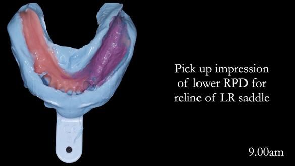 Newsletter 52 Managing Jo’s failing dentition with extractions and Mk 1/Mk 2 complete upper dentures and lower partial dentures FULL PROTOCOL