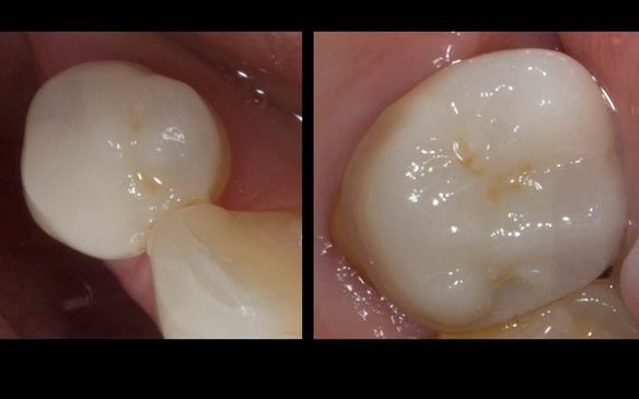 Figure 52 Porcelain fused to zirconia crown crowns incorporating parallel guiding surfaces, ledges and rest seats for the metal based partial dentures - fitted with Fuji plus cement.