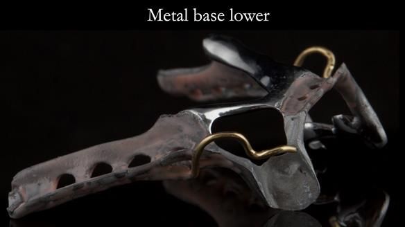 Finlay's Case Study Newsletter 40 - Immediate Mk 1 RPD to Definitive Mk 2 RPD - full protocol