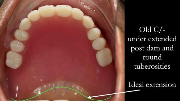 Managing poor implant positioning with complete dentures and Locator attachments - full protocol Newsletter 41