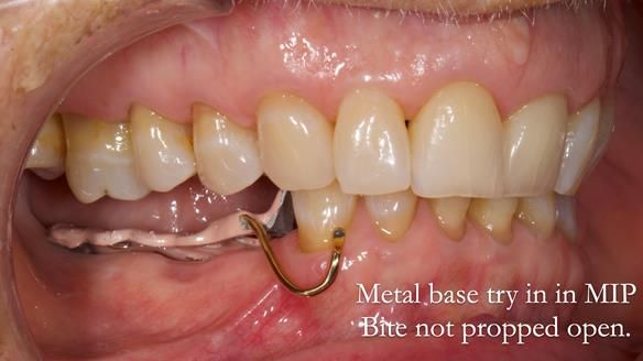 Finlay's Newsletter 61 provision of a lower unilateral free end saddle metal based partial denture for Joyce