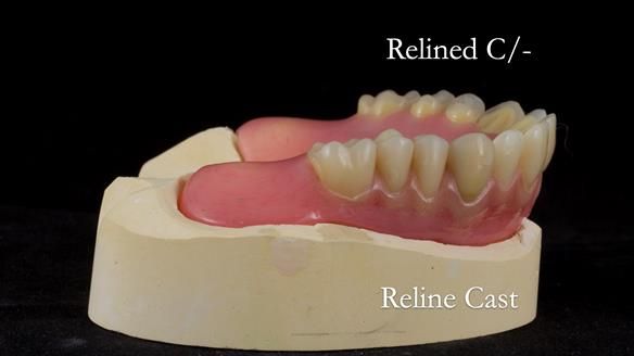 Newsletter 54 case presentation upper complete denture and lower Scandinavian designed hygienic partial denture for David