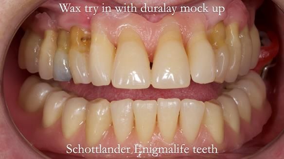 Finlay's Newsletter 59 Ultra hard partial dentures made for Gill