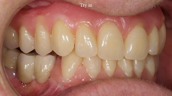 Newsletter 82 Mary - A complete upper and a one-tooth gasket denture