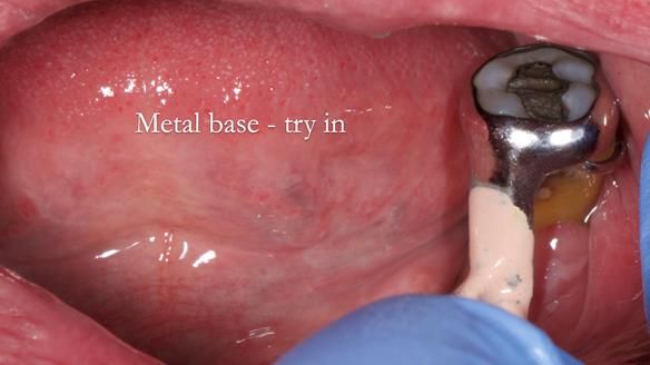 Finlay's Newsletter 59 Ultra hard partial dentures made for Gill