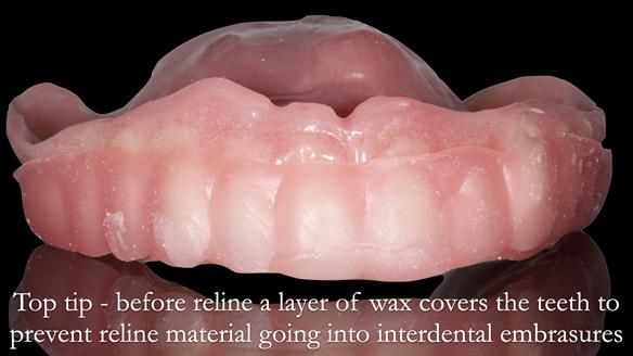 Newsletter 52 Managing Jo’s failing dentition with extractions and Mk 1/Mk 2 complete upper dentures and lower partial dentures FULL PROTOCOL