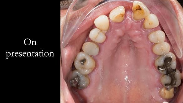 Finlay's Newsletter 63 Case study provision of metal based Scandinavian RPD - functional 10 years on