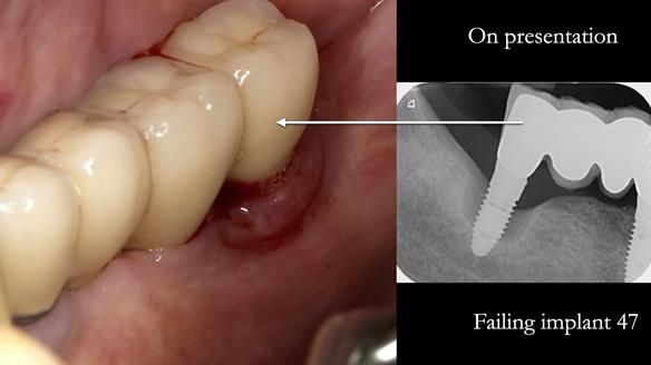 Ken – going downhill, first class