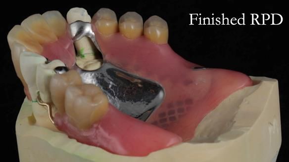 Finlay's Newsletter 59 Ultra hard partial dentures made for Gill