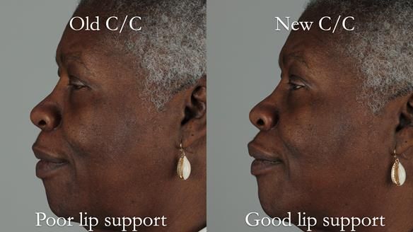 Newsletter 53 showing the making and fitting of ultra life-like dentures for Valena