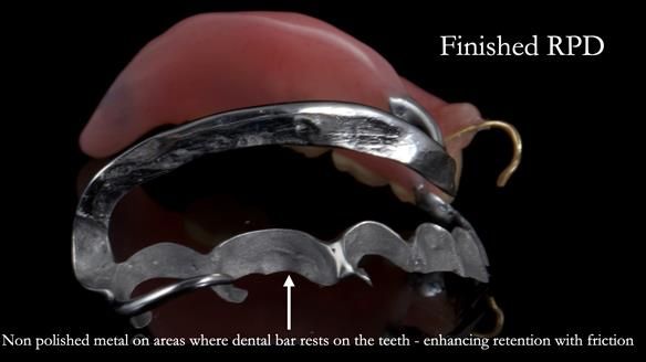 Finlay's Newsletter 61 provision of a lower unilateral free end saddle metal based partial denture for Joyce