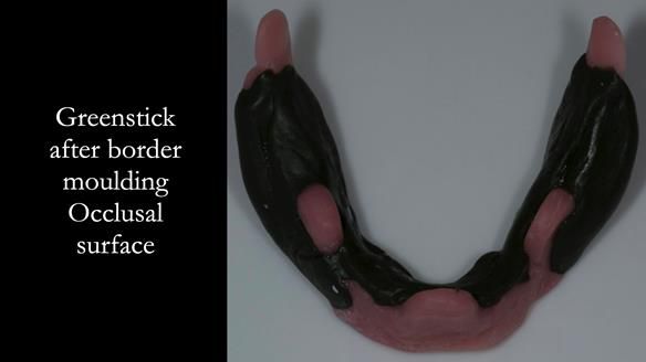 Newsletter 75: Marion’s case - Step-by-step complete denture workflow