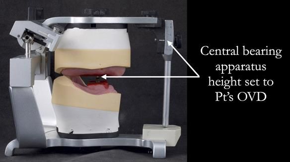 Complete denture Class II div 2 deep overbite Newsletter 39