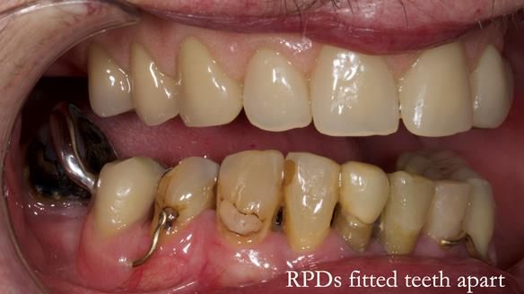 Newsletter 55 Provision of metal based partial dentures for Zephyrine with a repaired cleft lip and palate