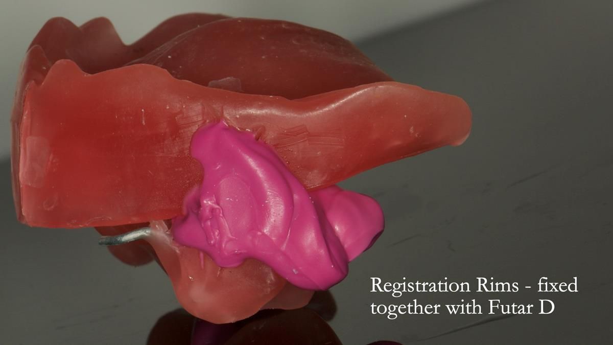 Newsletter 87 – Father Peter: A Partial Denture that needed Minor Miracle