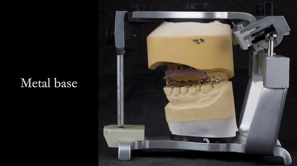 Upper metal base partial denture/occlusal stabilisation splint/obturator - full protocol