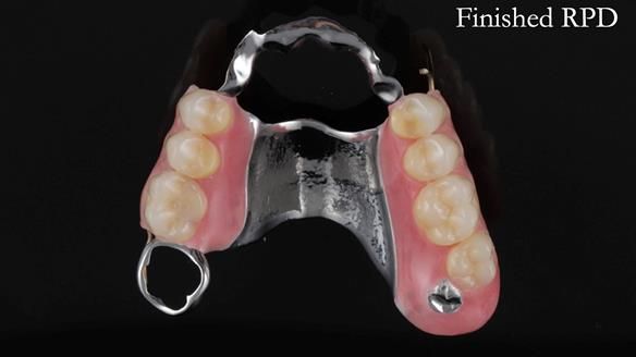 Finlay's Newsletter 60 Sylvia's upper Kennedy Class 2 Mod 1 metal based upper RPD