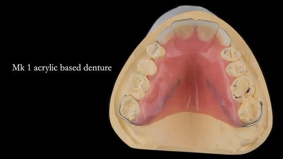 Finlay's Newsletter 63 Case study provision of metal based Scandinavian RPD - functional 10 years on