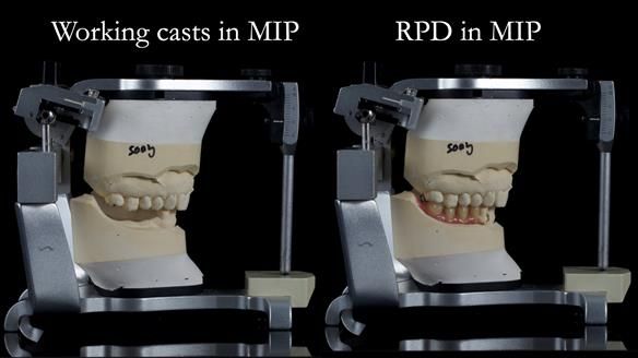 Finlay's Newsletter 61 provision of a lower unilateral free end saddle metal based partial denture for Joyce