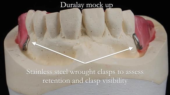 Newsletter 56 showing the making and fitting of a bilateral free end saddle upper removable partial denture (RPD) for patient with pemphigus