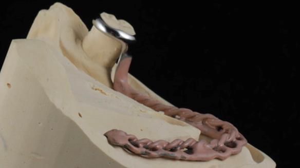 Finlay's Newsletter 59 Ultra hard partial dentures made for Gill