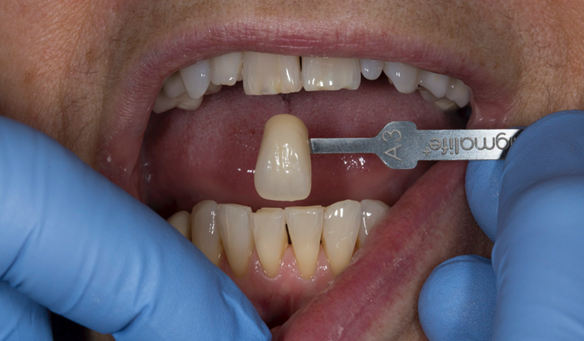 Figure 13 A3 shade of teeth prior to commencing treatment and whitening