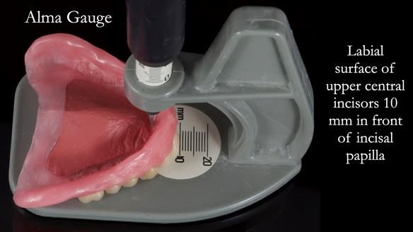 Newsletter 80 - Gordon’s dentures: the one case in 1,000 where my technique failed