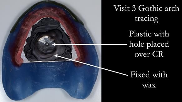 Newsletter 53 showing the making and fitting of ultra life-like dentures for Valena