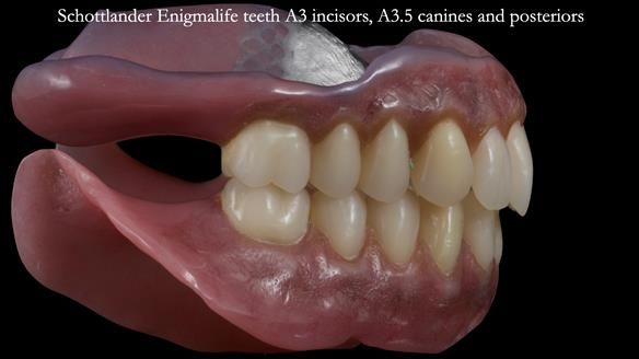 Newsletter 53 showing the making and fitting of ultra life-like dentures for Valena